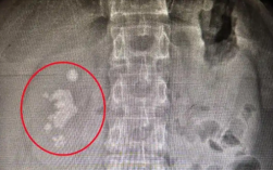 男子查出肾结石未重视拖成大麻烦：发展为铸型结石填满肾脏！