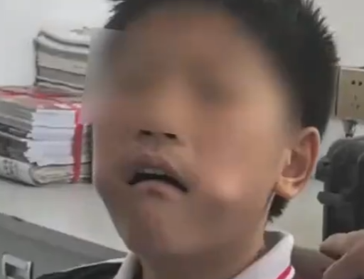 男孩把三角尺塞进嘴中被卡 消防赶到后将尺子夹碎取出！-图1