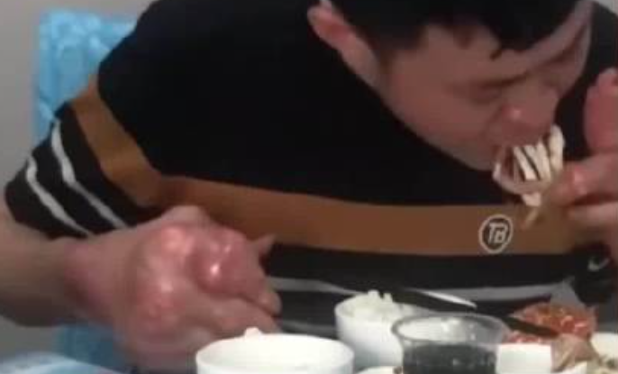 男子爱喝啤酒吃海鲜 患痛风双手变形已无法工作！-图1